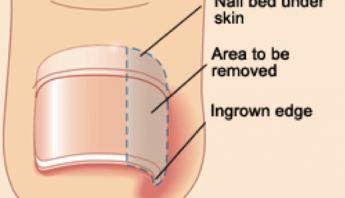 Podiatrist Ingrown Toenail