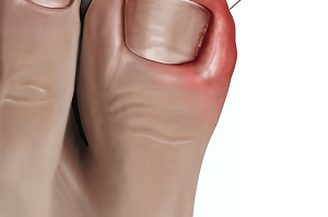 Ingrownt Toenail Surgery Hobart