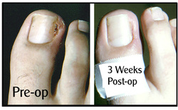 ingrown toenail removal before and after